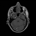 MRI of head